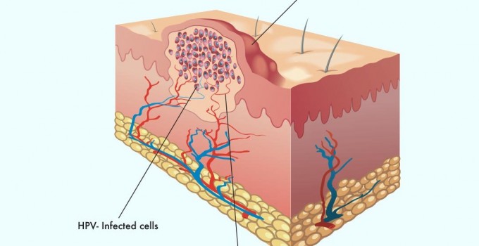 warts-what-are-they-and-why-do-i-have-them-ips-compounding